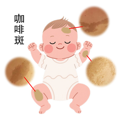 <strong>咖啡斑胎记去除的费用大概多少？按面积算吗？</strong>