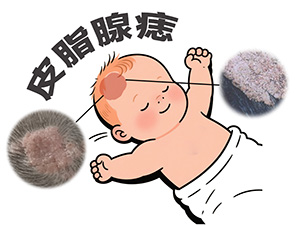 <strong>婴儿头皮上的黄色斑块摸着有点油，是不是皮脂腺痣？</strong>