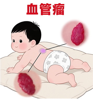 <strong>长出血管瘤是什么原因？婴幼儿为什么容易长？</strong>