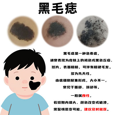 宝宝胎记治疗后怎么护理？南京胎记哪家好？